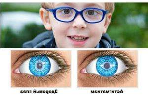 астигматизм у детей