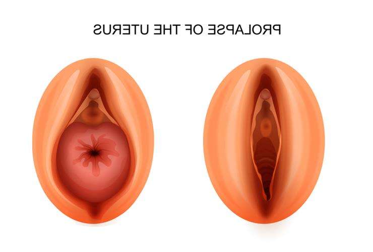 Выпадение матки у женщин осмотр