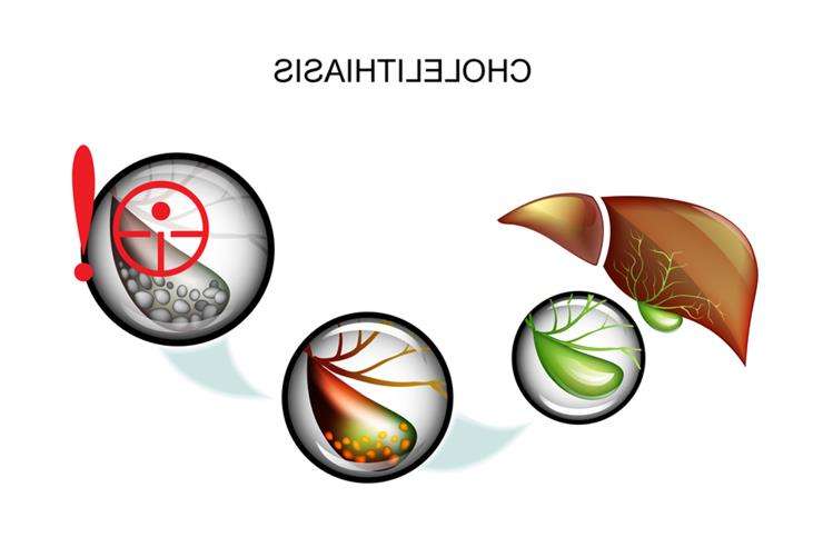 диета при холецистите