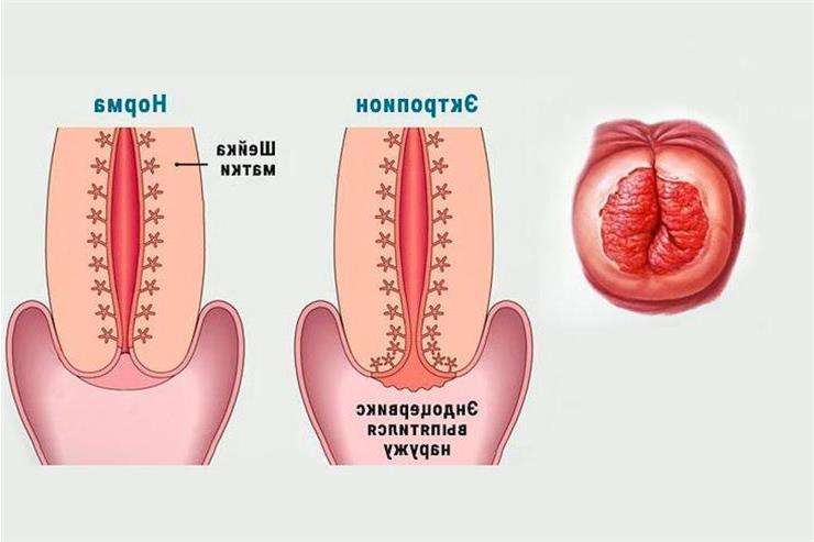эктропион шейки матки