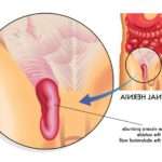Причини розвитку та методи лікування пахової грижі у дітей