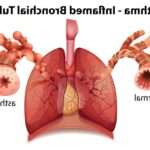 Ознаки і методи лікування бронхіальної астми у дітей