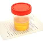 Плоский епітелій в сечі у жінок: нормальне значення, причини збільшення епітеліальних клітин