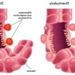 Симптоми і лікування дівертікуліта кишечника