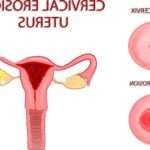 Діагностика та лікування ендоцервікозу шийки матки