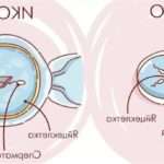 Переваги та особливості ЕКО ІКСІ