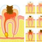 Причини і лікування пульпіту у дітей