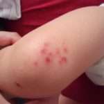 Як лікувати стрептодермію у дитини?