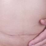 Чому утворюються спайки після кесаревого і як їх лікувати