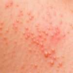 Причини прищів на статевих губах