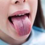 Причини, симптоми і лікування географічного мови у дитини