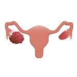 Симптоми і лікування полікістозу яєчників