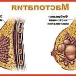 Фіброзно-кістозна мастопатія: симптоми і лікування