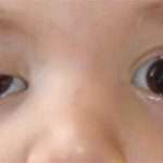 Причини і лікування амбліопії у дітей