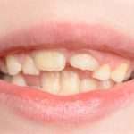 Криві зуби у дітей: причини, лікування та профілактика