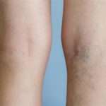 Перші ознаки варикозного розширення вен у жінок