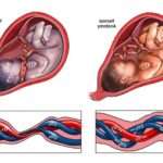 Коротка пуповина при пологах: причини, ускладнення та усунення