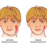 Як проявляється свинка у дітей, наслідки епідемічного паротиту