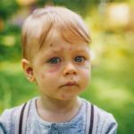 Доктор Комаровський пояснив, як допомогти потерпілому від укусу комахи