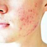 Можна використовувати йод для лікування висипань на обличчі