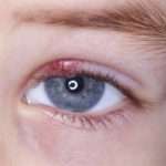 Причини, симптоми і лікування ячменю у дитини