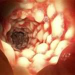 Як проявляється хвороба Крона у дітей та чим її лікувати