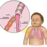 Бронхіоліт у дітей: симптоми захворювання і методи терапії