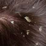 Лупа у дітей: підходи до лікування