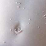 Як проявляється контагіозний молюск у дітей