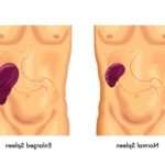 Чому збільшена селезінка у дитини: що це означає, як лікувати