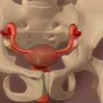 Оофорит в хронічній і гострій формі