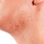 Причини прищів на шиї і під щелепою у жінок