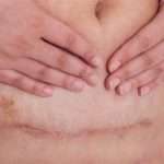 Як проходить вагітність після кесарева перетину