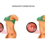 Навіщо встановлюють кільце на шийку матки при вагітності