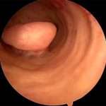 Як лікувати аденоматозный поліп ендометрію?