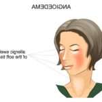 Симптоми набряку Квінке у дітей і правила надання першої допомоги