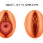 Як лікується випадання матки у жінок