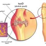 Дієта при подагрі: чим харчуватися, щоб уникнути загострень