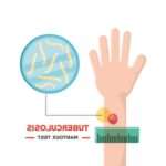 Протипоказання Манту: кому не можна робити реакцію?