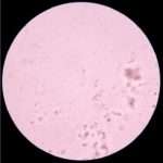 Лейкоцитарна естераза в сечі у дитини