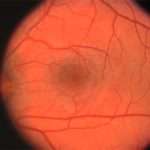 Що таке ретинопатія недоношених? Які причини розвитку захворювання?