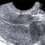 Рубець на матці після кесаревого розтину