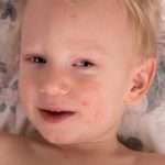 Як проявляється алергія на солодке у дітей і як її лікувати