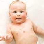 Іхтіоз шкіри у дітей – що це таке, чим небезпечно