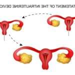 Як працює внутрішньоматкова спіраль: плюси і мінуси контрацепції
