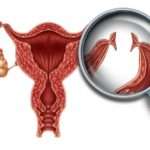 Показання та методи проведення стерилізації жінок