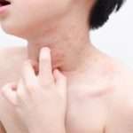 Симптоми і лікування кропивянки у дітей