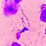 Все про причини, симптоми і лікування грибкових жіночих патологій