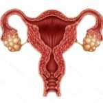 Метроэндометрит: як боротися з патологією