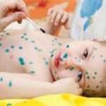 Залишаються шрами після вітрянки і як від них позбавитися